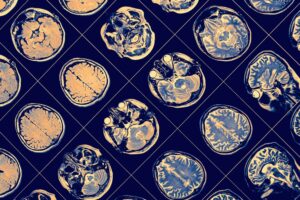Brain-MRI