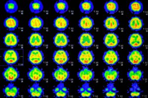 PET-Brain-scan
