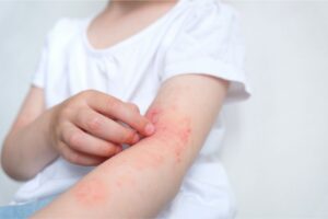 child-allergic-reaction