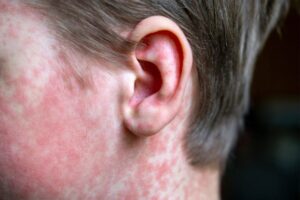 measles-rash