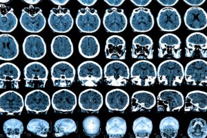 brainscans